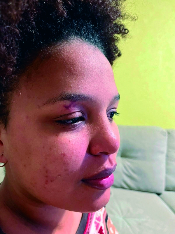 A estudante Mariana Batista ficou com escoriações após ser agredida por um homem que se identificou como bolsonarista. O presidente do Sindicato José Ferreira, que participou do ato pacífico, criticou a violência
